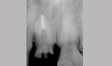 Dentures treatment in Anand
                        